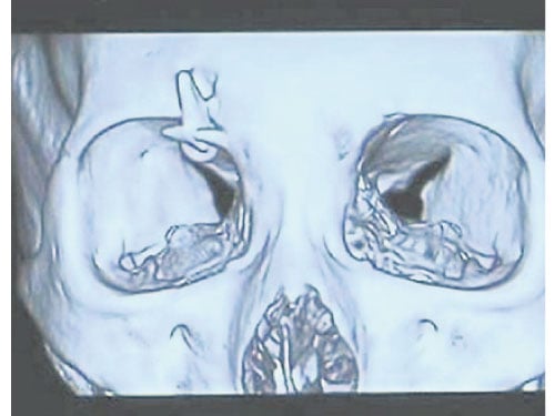 ■從X光照片中看到，一顆牙齒正好“釘”在婷婷右眼眉骨。 （互聯網）