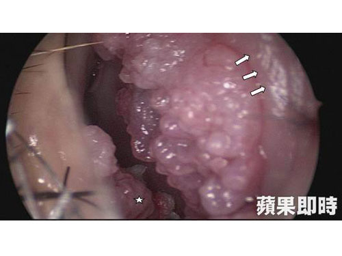 男子右侧鼻孔内有许多如花椰菜般的菜花。图/台湾《苹果日报》