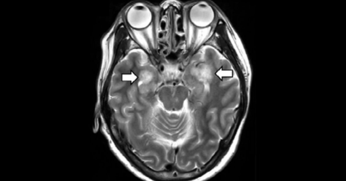 58岁妇女的脑部扫描显示，箭头的部分是脑细胞坏死和发炎的地方。