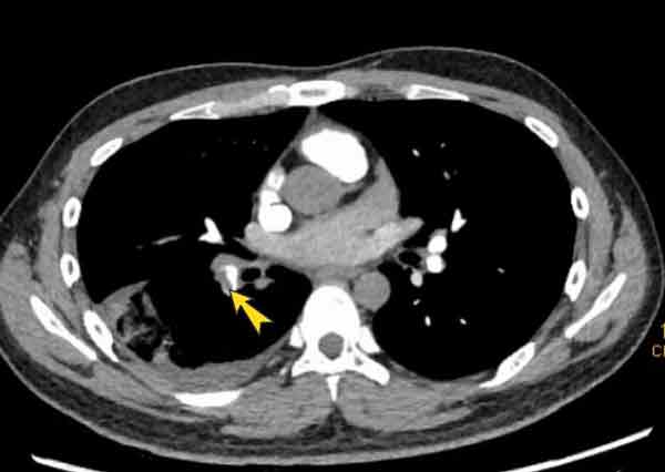 sedentary,pain,Pulmonary Infarction