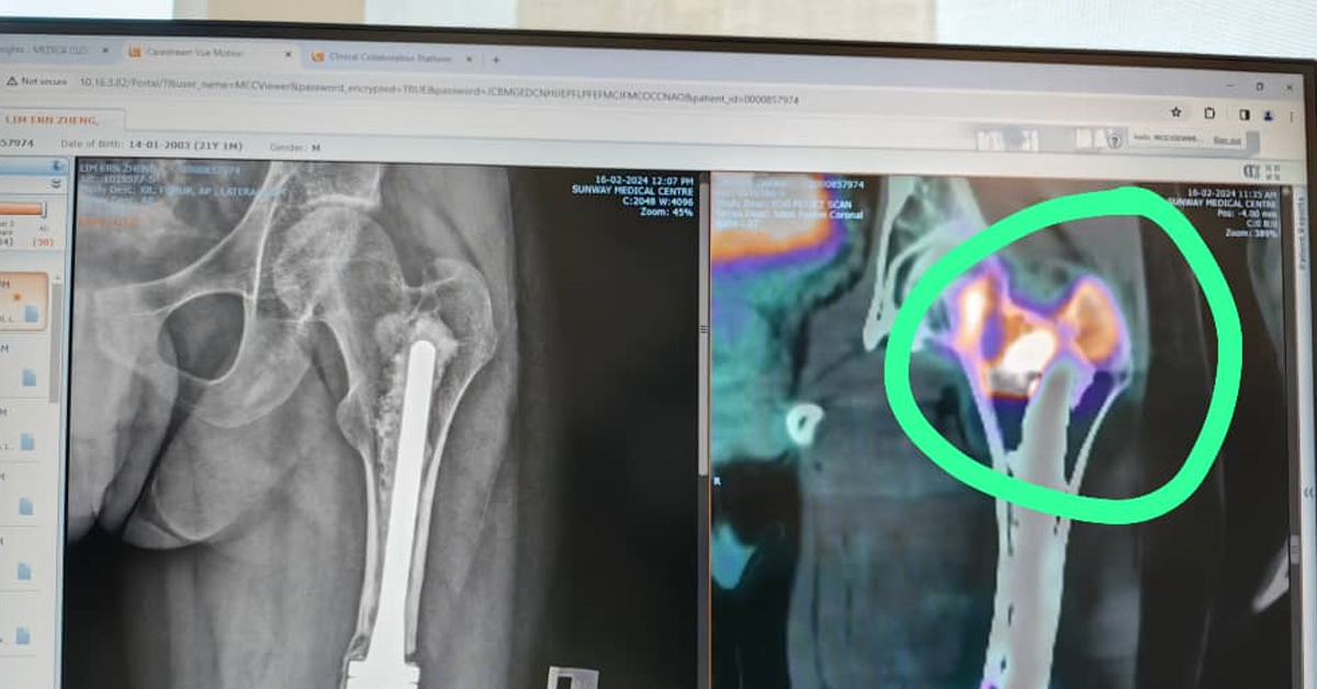 林恩征的X光片（圆圈处）显示，盘骨部位的骨头已出现骨质疏松。（沈春祥提供）