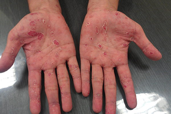 手掌出现红疹是梅毒的症状之一。