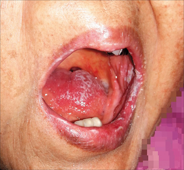 图为受念珠菌感染的口腔示意图，非当事人。