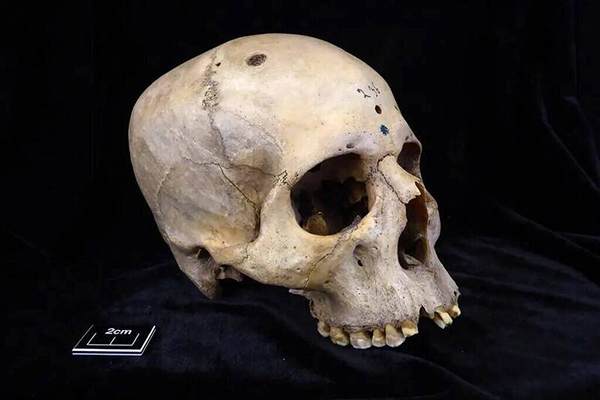 一名年龄在30至35岁之间的古埃及男子头骨，年代约在公元前2687至2345年间，被发现其头骨边缘有切割痕迹，据研判这些痕迹围绕着因脑癌转移而形成的数十个病灶。