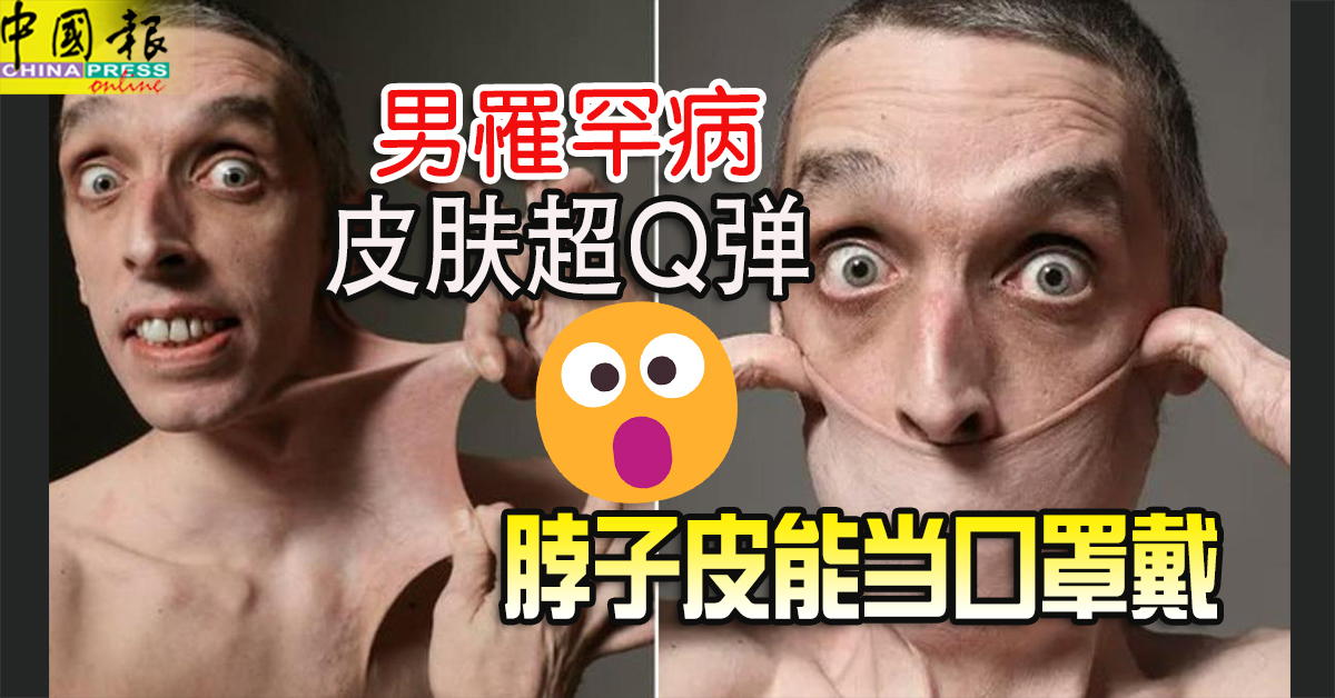 男罹罕病皮肤超Q弹　脖子皮能当口罩戴